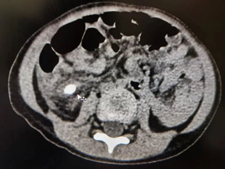 3歲男童高燒不退，這種情況家長切莫大意