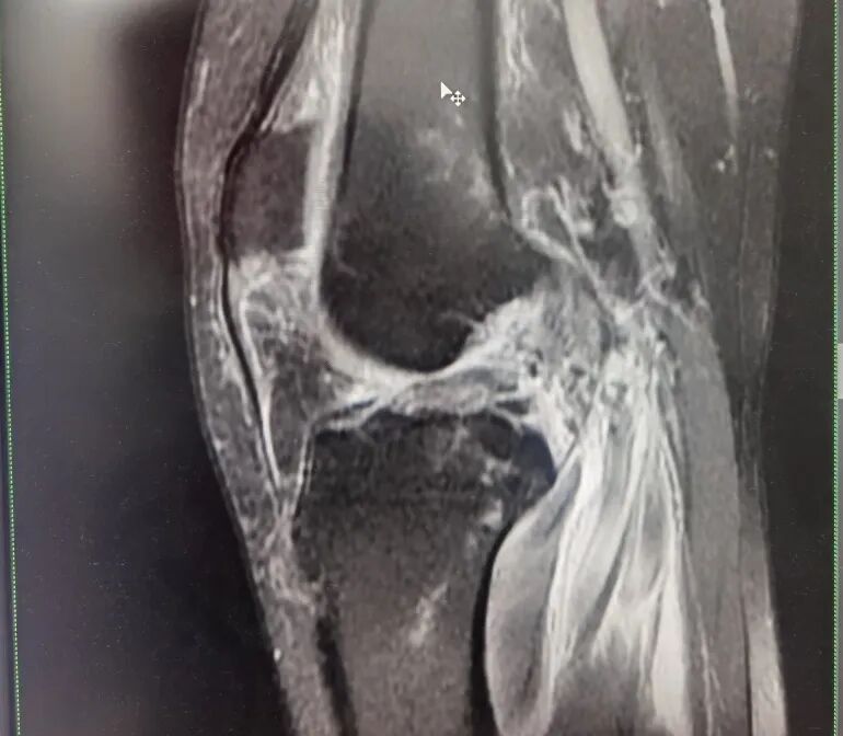 解決“隱形殺手”，重啟行動“自由” ——廣濟醫(yī)院常規(guī)開展關節(jié)鏡下人工韌帶重建術